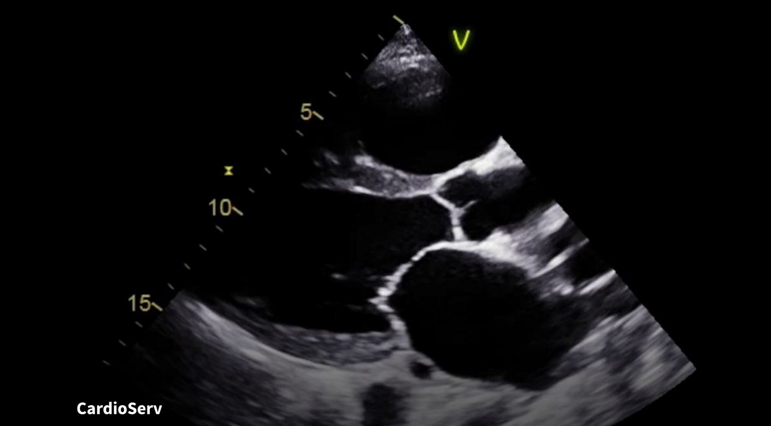 1.0 CME - Mitral Regurgitation: Secondary Mechanism - Cardioserv