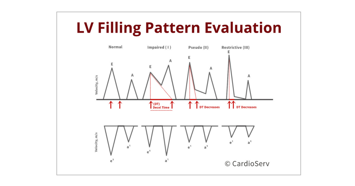 Understanding The Basics LV Filling Patterns Cardioserv