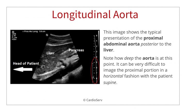 Abdominal Ultrasound For Echocardiographers Aorta And Ivc Cardioserv