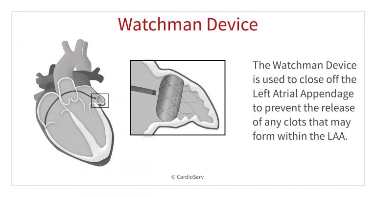 What is the Watchman Device and How Does it Work? Cardioserv