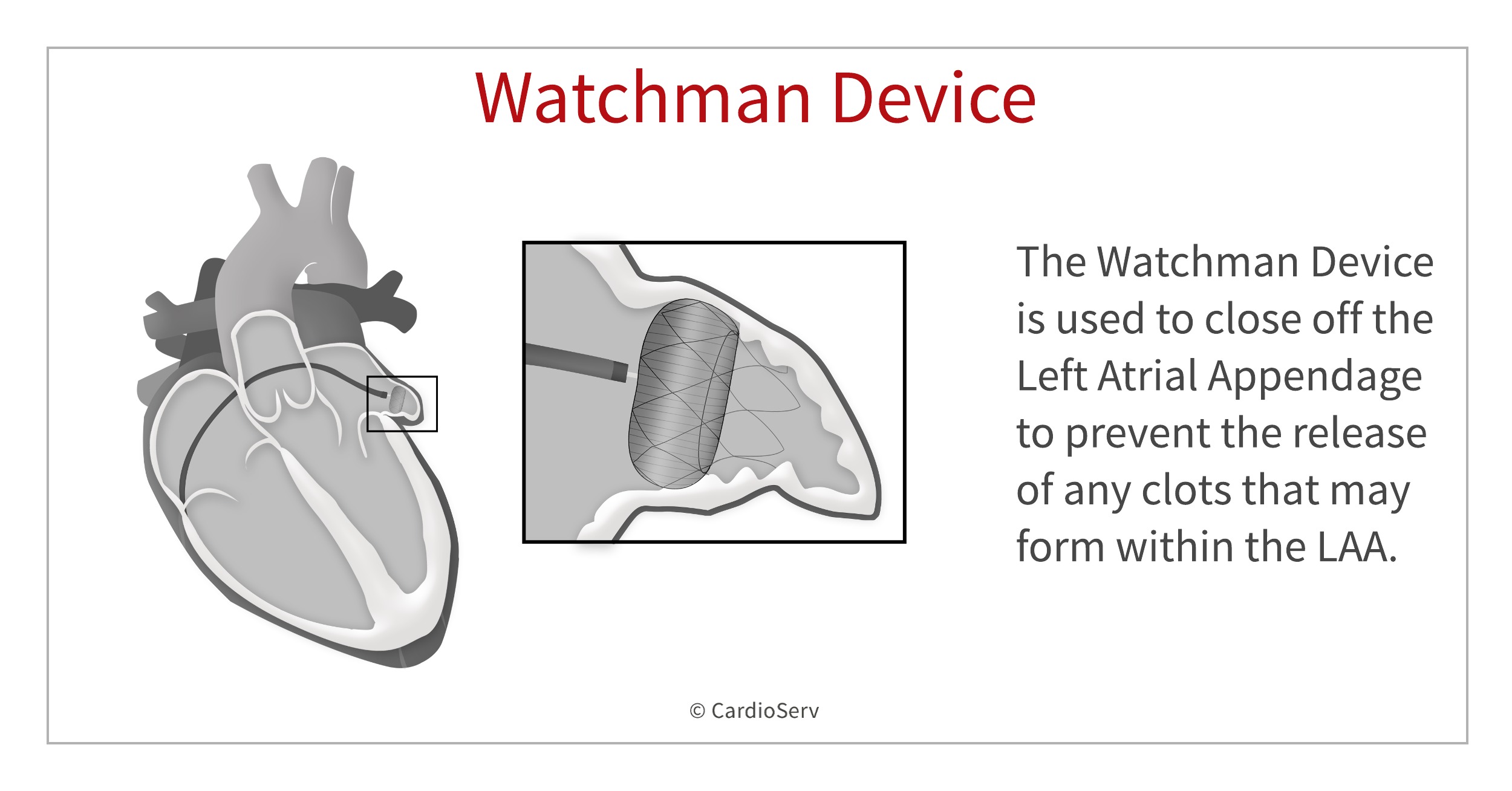 Watchman Device Problems 2024 Icd 10 Kelsi Mellie