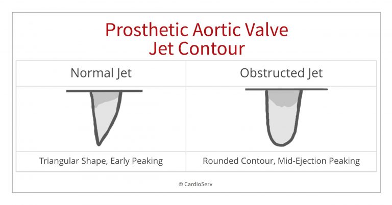 Prosthetic Aortic Valve Stenosis Cardioserv