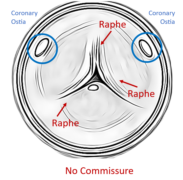 unicuspid aortic valve, acommissural valve, echocardiography, echo