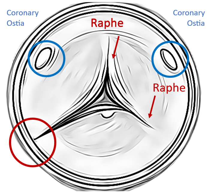 Unicuspid Aortic Valve in Echo